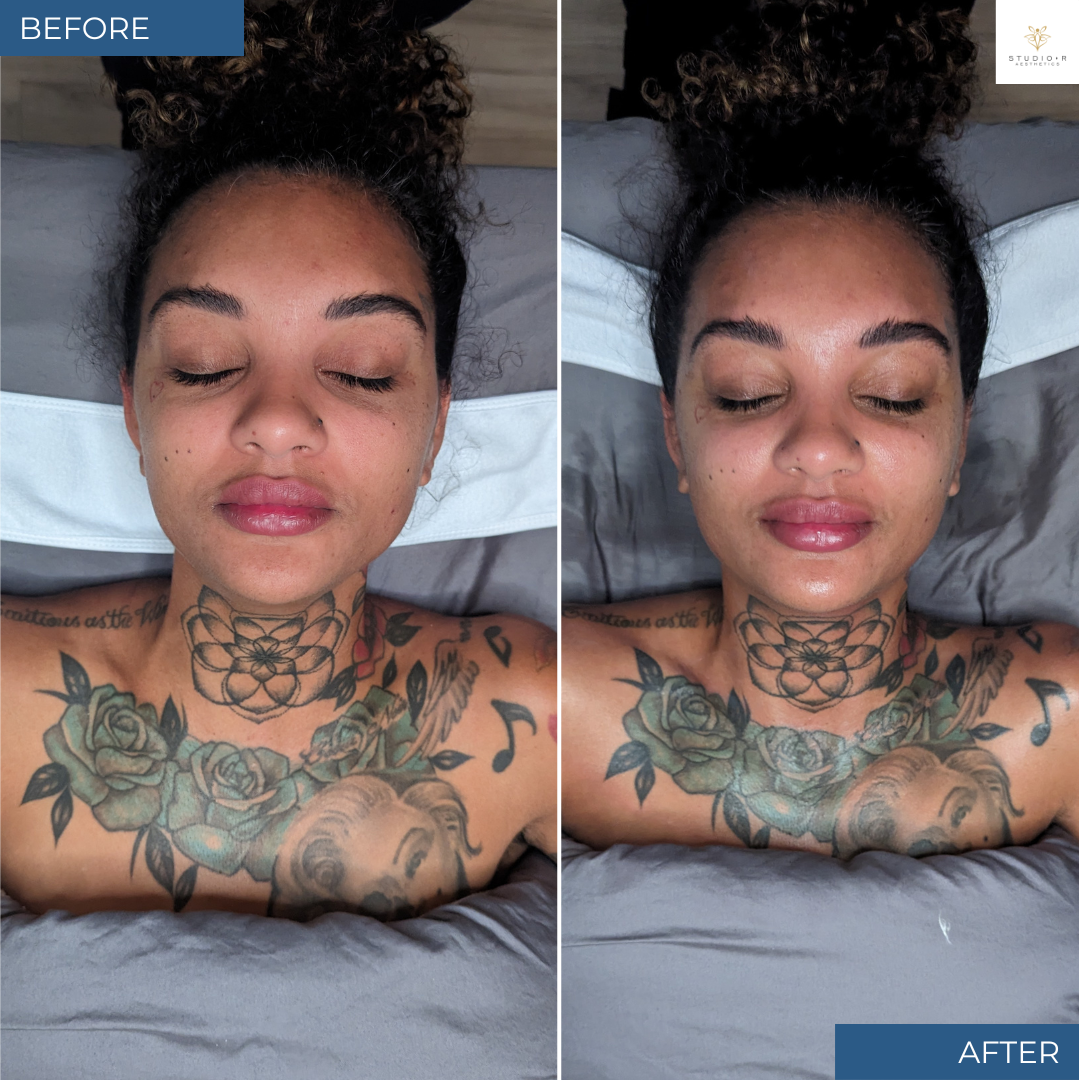 Customized Skin Treatment Before and After by Master Esthetician