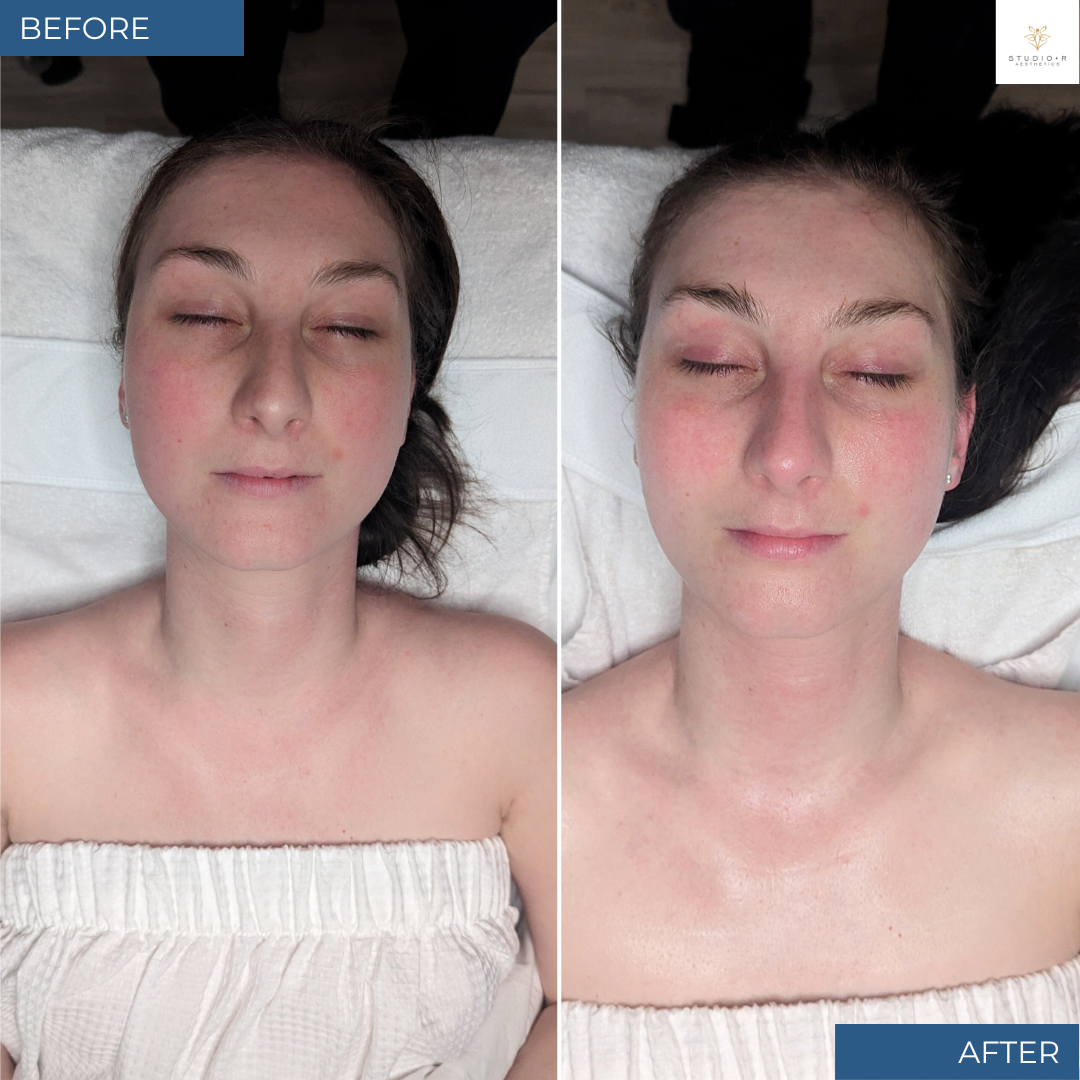 Customized Skin Treatment Before and After by Master Esthetician in Charlottesville Virginia