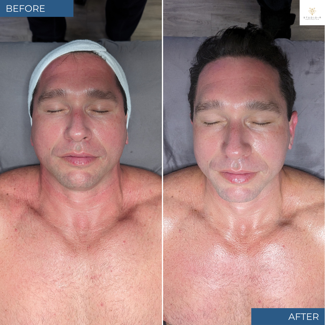 Platinum Hydrafacial Before and After at Studio R Aesthetics in Charlottesville Virginia